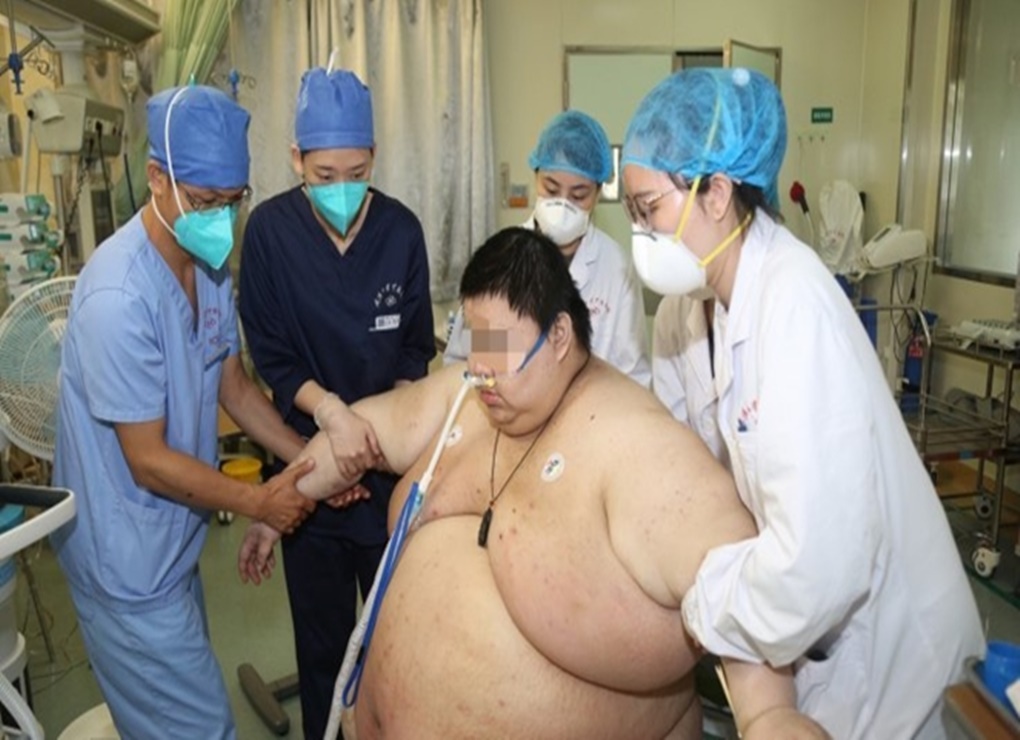 Pria Cina Ini Berat Badannya Naik 100 Kg