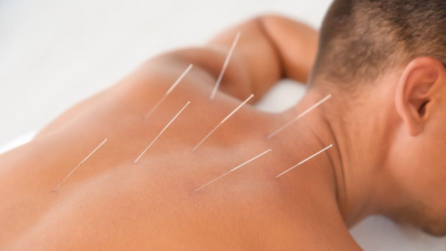 Manfaat Terapi Akupunktur untuk Kesehatan